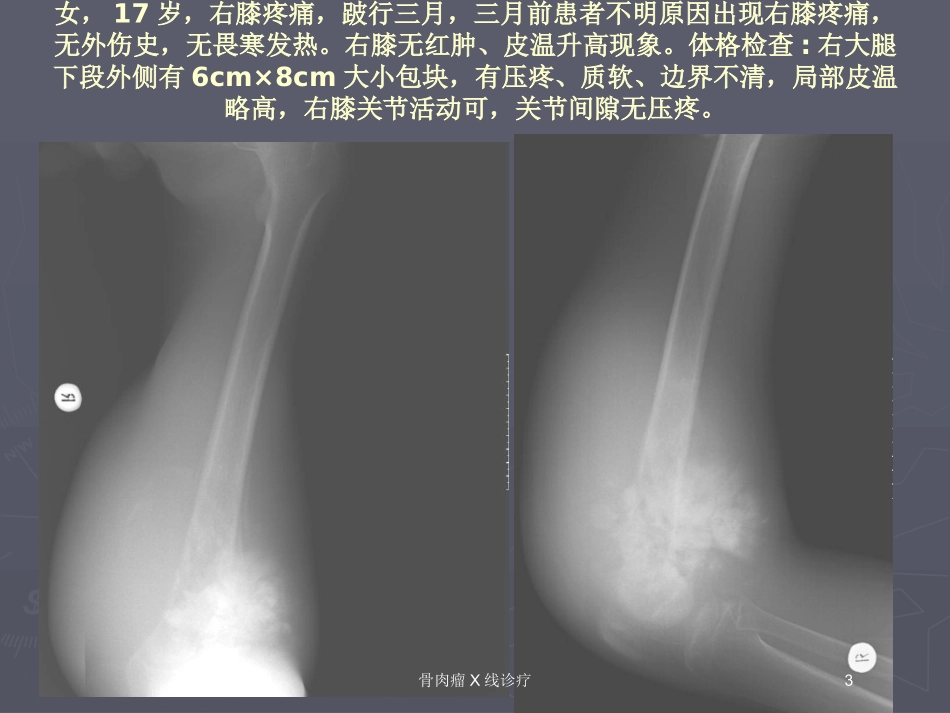 骨肉瘤X线诊疗培训课件.pptx_第3页