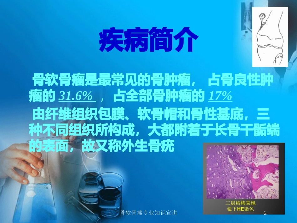 骨软骨瘤专业知识宣讲培训课件.pptx_第2页