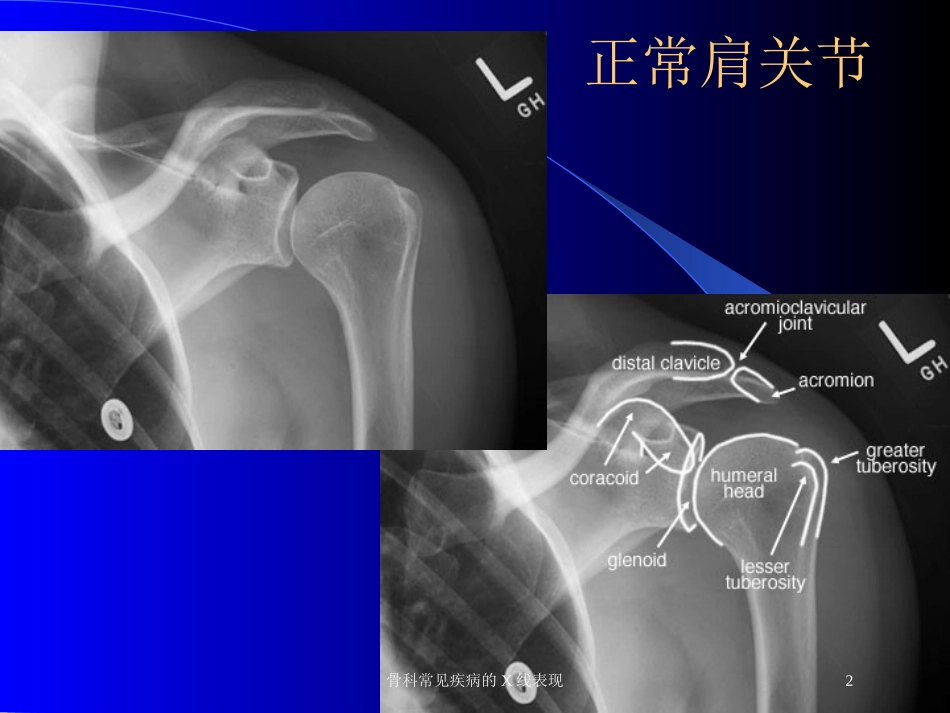 骨科常见疾病的X线表现培训课件.pptx_第2页