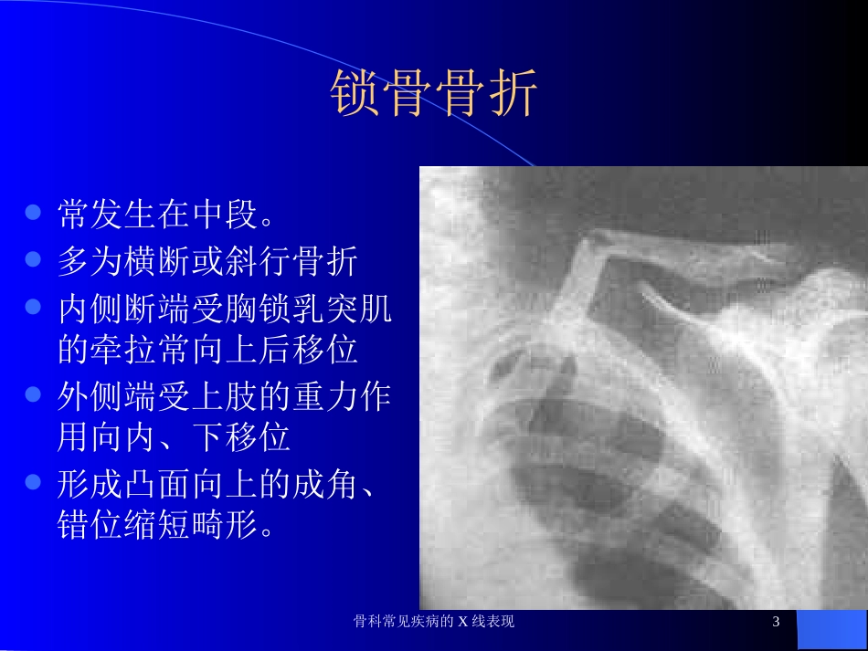 骨科常见疾病的X线表现培训课件.pptx_第3页