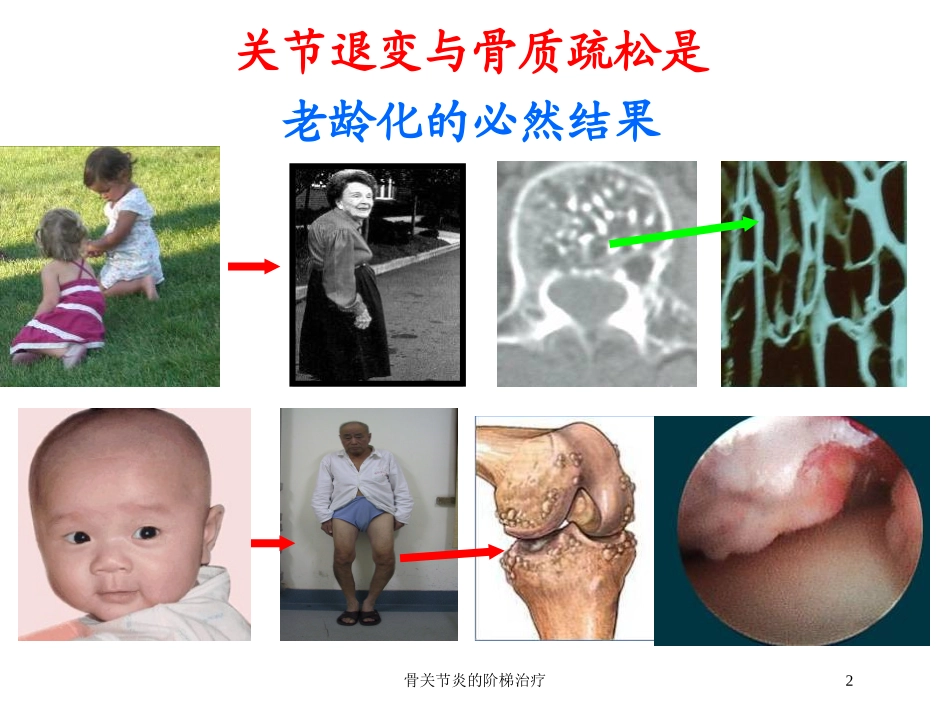 骨关节炎的阶梯治疗培训课件.pptx_第2页