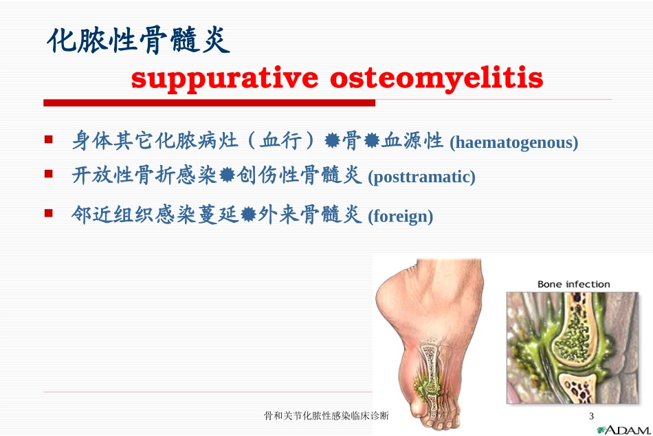 骨和关节化脓性感染临床诊断培训课件.pptx_第3页