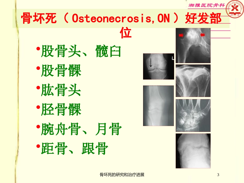 骨坏死的研究和治疗进展培训课件.pptx_第3页