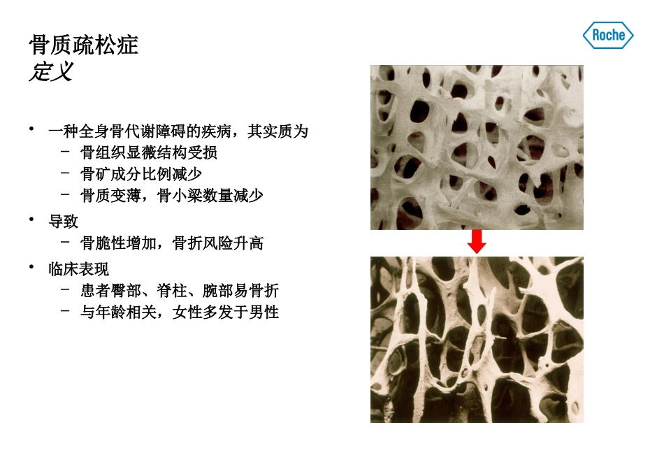 骨代谢标志物和骨质疏松症培训课件.pptx_第2页
