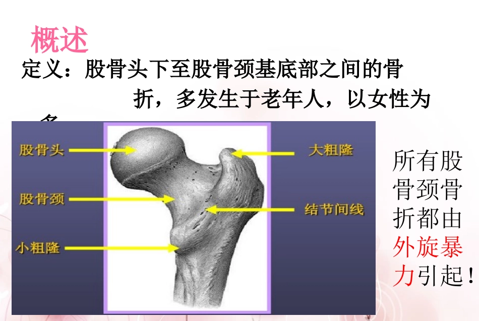 股骨颈骨折护理查房培训课件.pptx_第2页