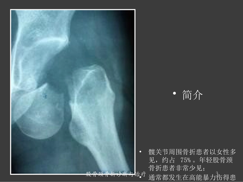 股骨颈骨折诊断与治疗培训课件.pptx_第3页