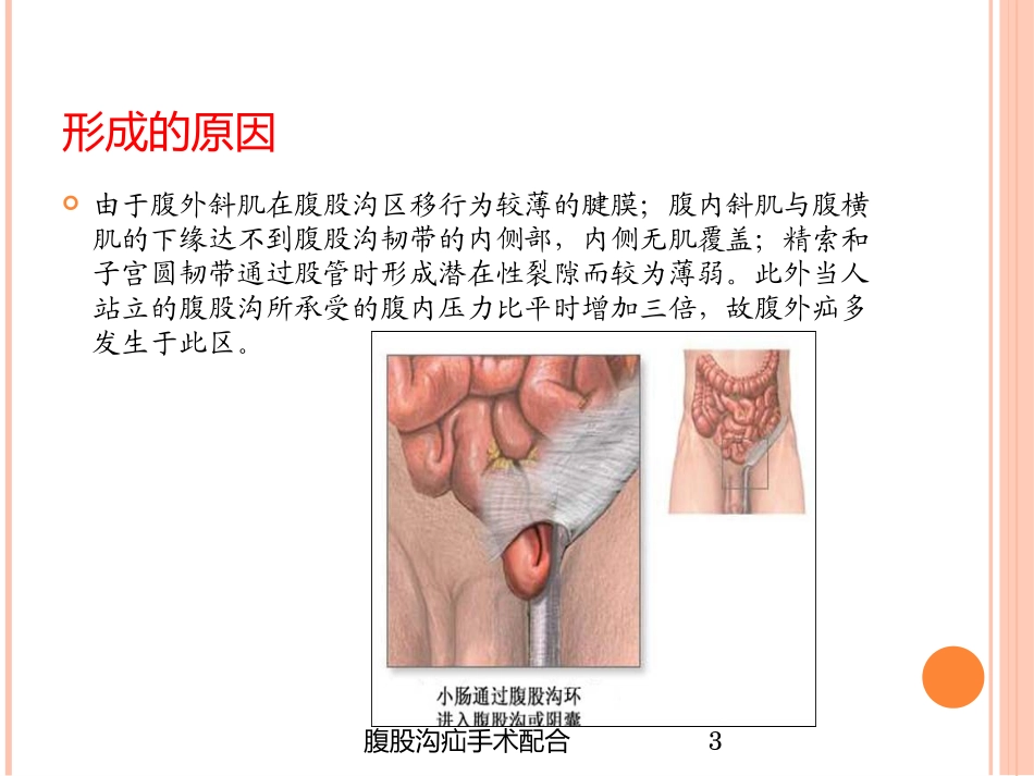 腹股沟疝手术配合培训课件.pptx_第3页