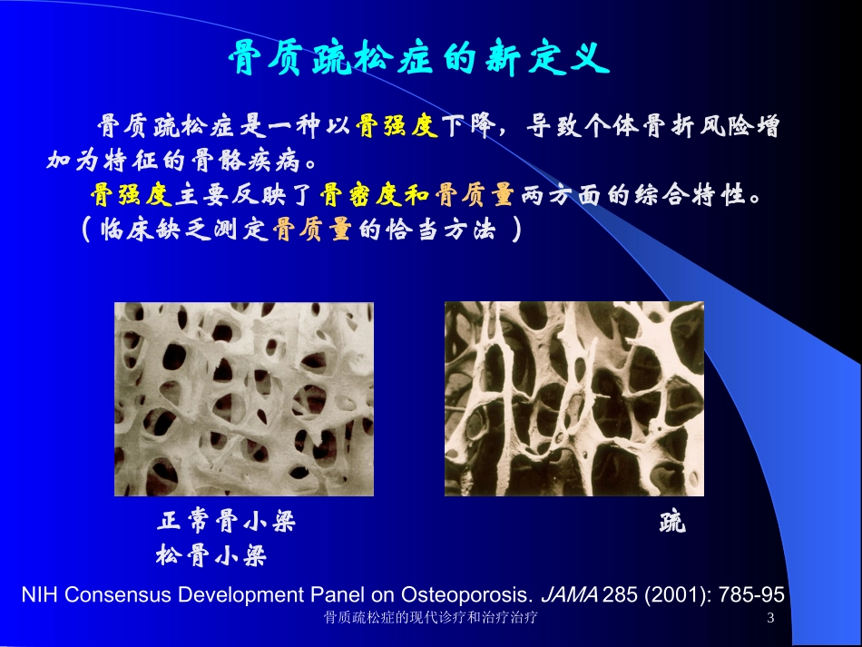 骨质疏松症的现代诊疗和治疗治疗培训课件.pptx_第3页