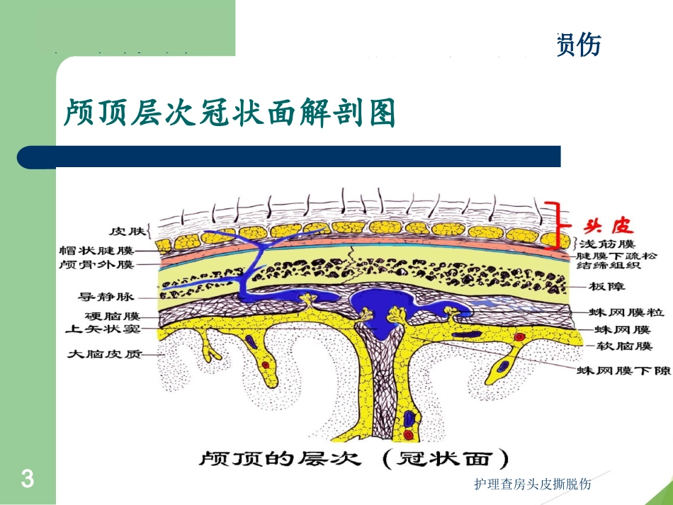护理查房头皮撕脱伤培训课件.pptx_第3页