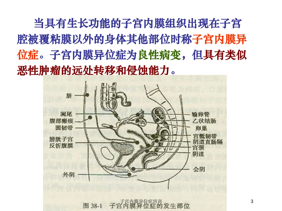 子宫内膜异位症培训培训课件.pptx_第3页