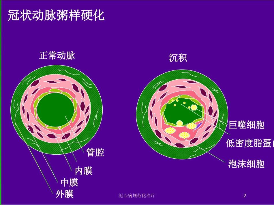 冠心病规范化治疗培训课件.pptx_第2页