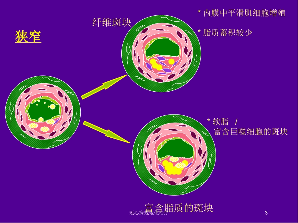 冠心病规范化治疗培训课件.pptx_第3页
