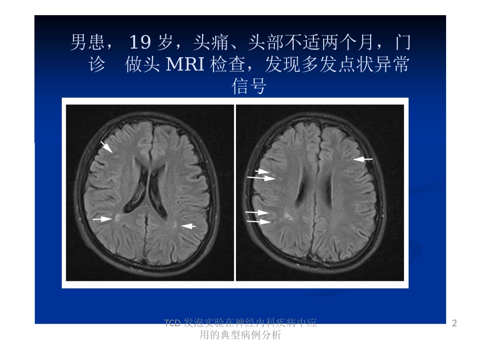 TCD发泡实验在神经内科疾病中应用的典型病例分析培训课件.pptx_第2页