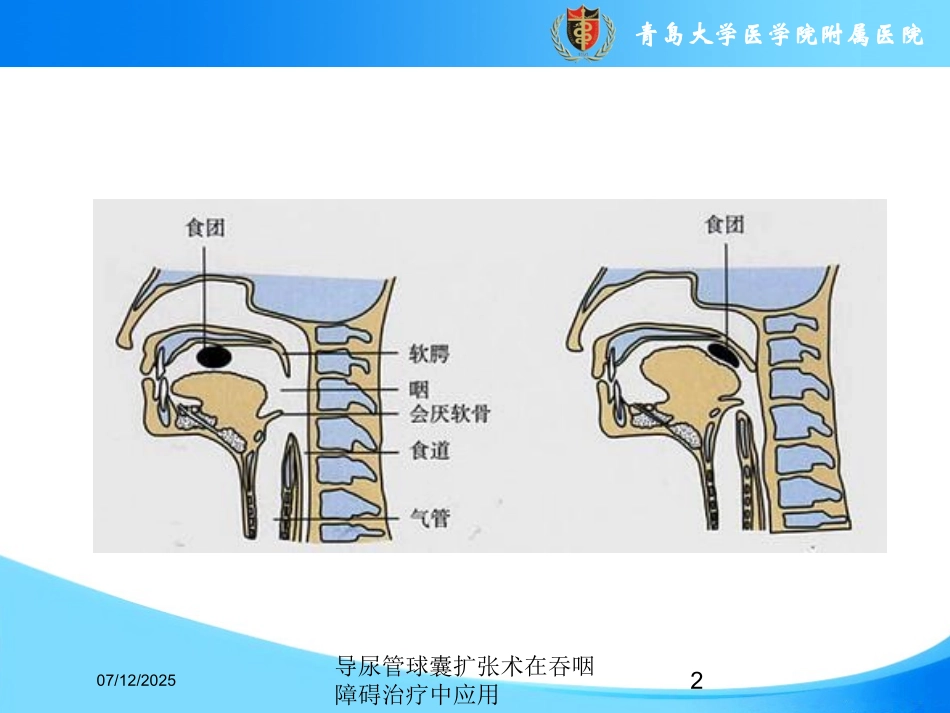 导尿管球囊扩张术在吞咽障碍治疗中应用课件.pptx_第2页