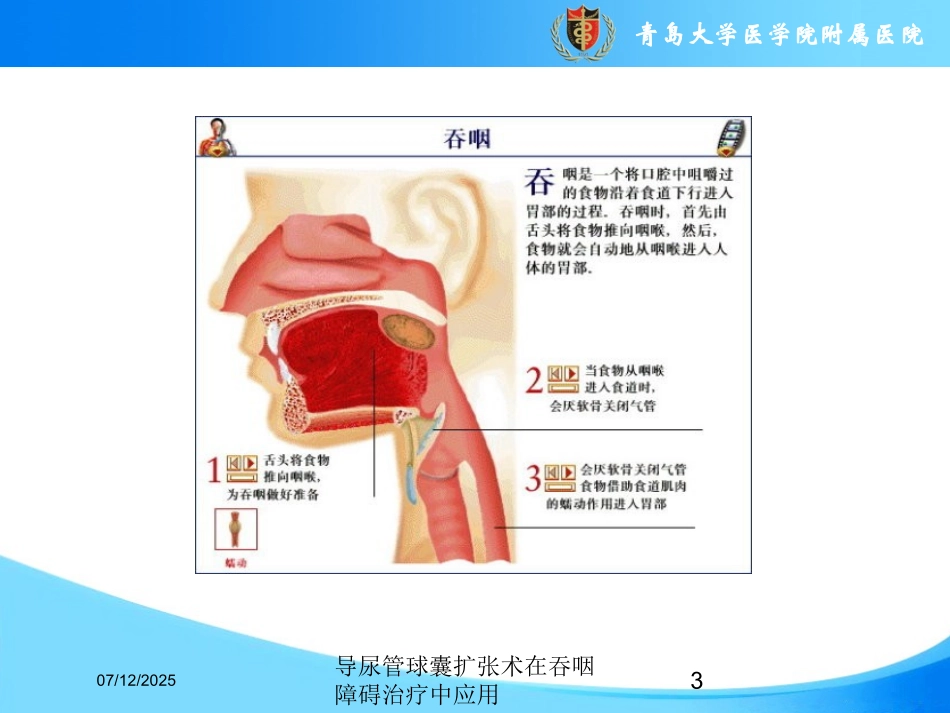 导尿管球囊扩张术在吞咽障碍治疗中应用课件.pptx_第3页