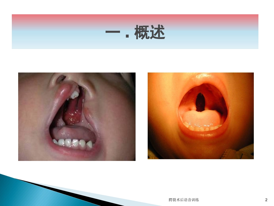 腭裂术后语音训练培训课件.pptx_第2页