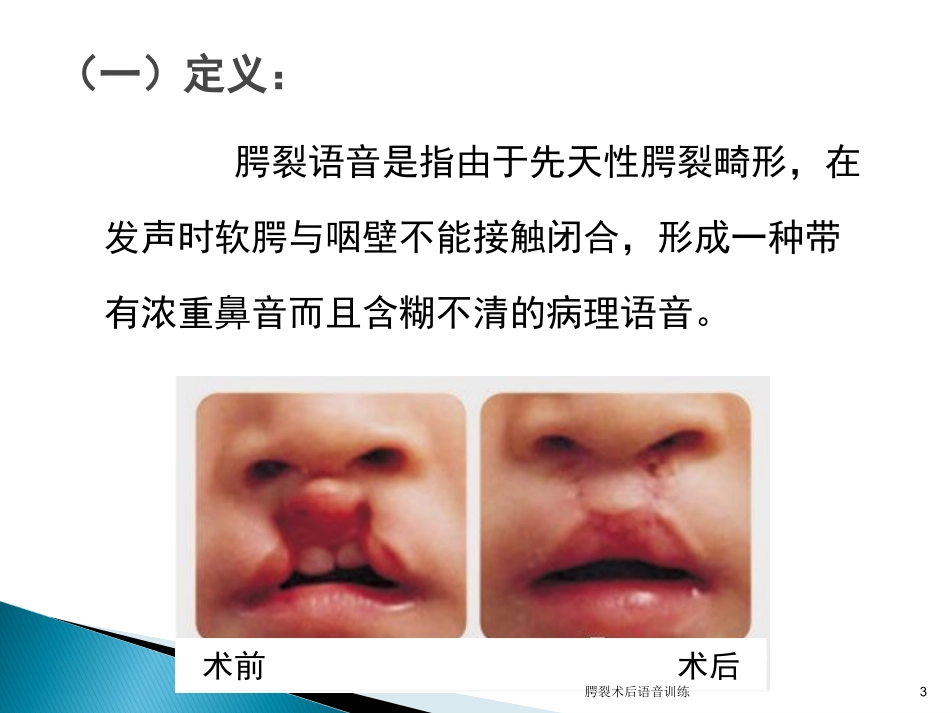 腭裂术后语音训练培训课件.pptx_第3页
