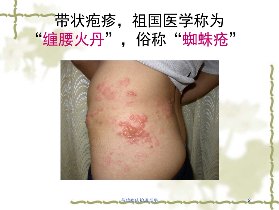 带状疱疹护理查房培训课件.pptx_第2页