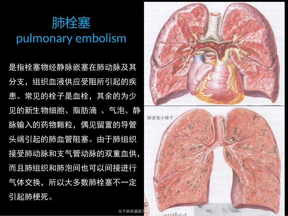 关于肺栓塞医学知识专题讲座培训课件.pptx_第2页