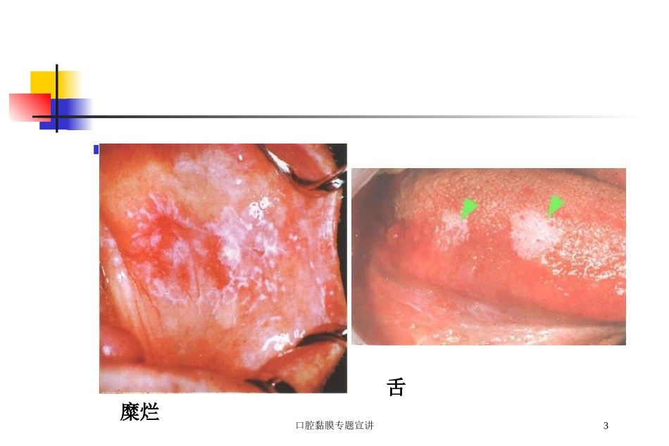 口腔黏膜专题宣讲培训课件.pptx_第3页