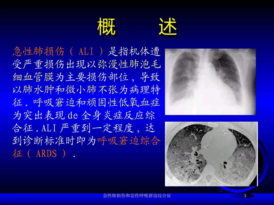 急性肺损伤和急性呼吸窘迫综合征培训课件.pptx_第3页