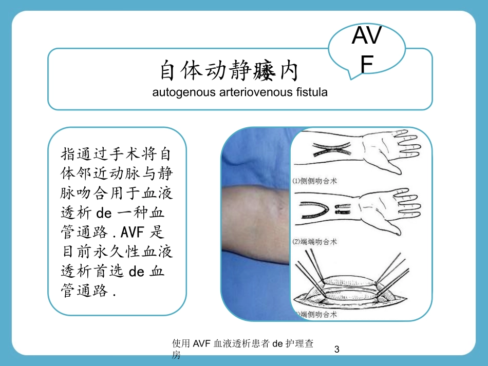 使用AVF血液透析患者的护理查房培训课件.pptx_第3页