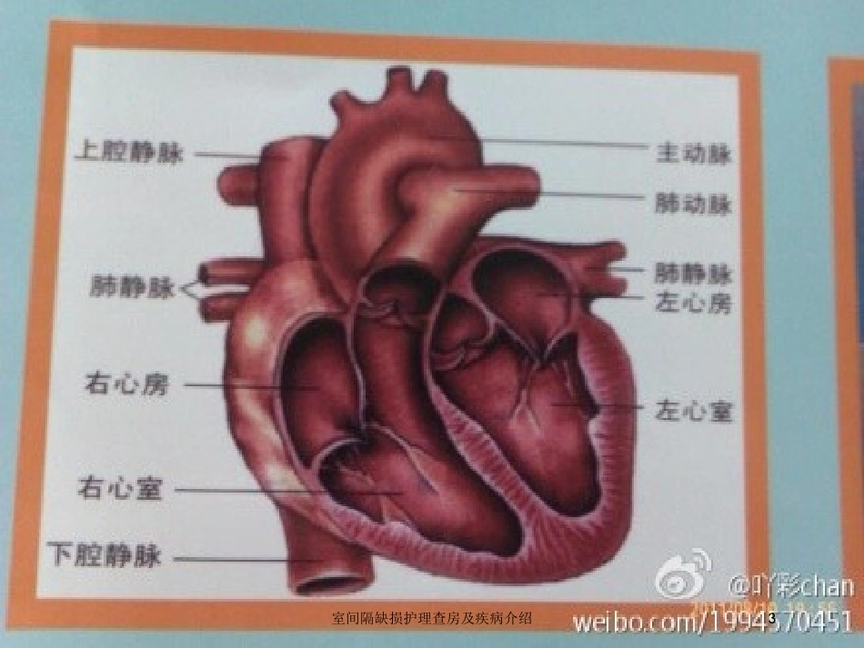 室间隔缺损护理查房及疾病介绍培训课件.pptx_第3页
