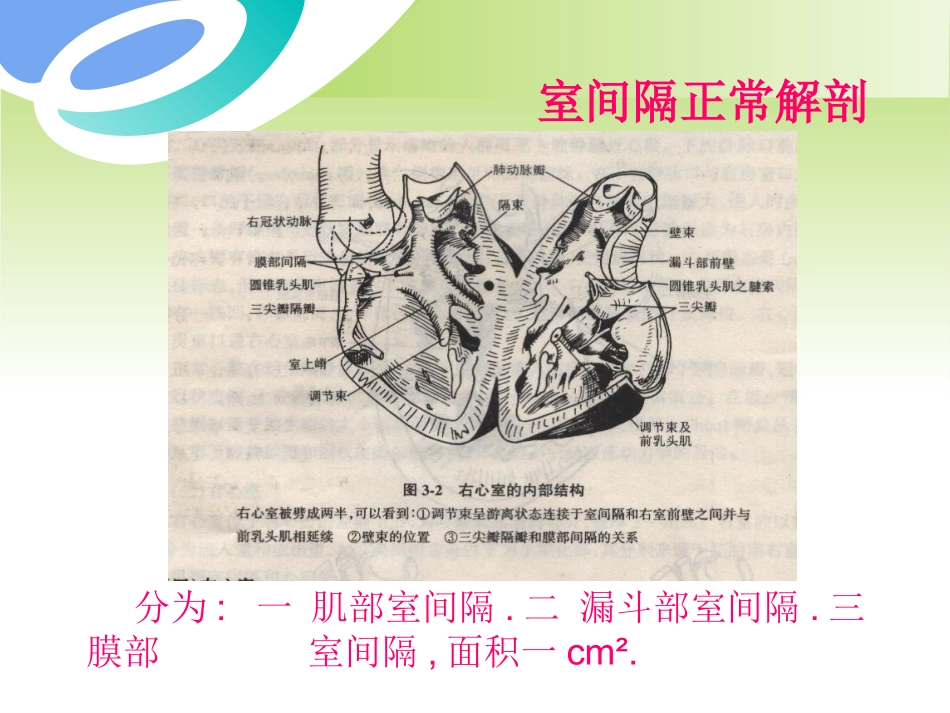 室间隔缺损及相关鉴别的超声诊断培训课件.pptx_第3页