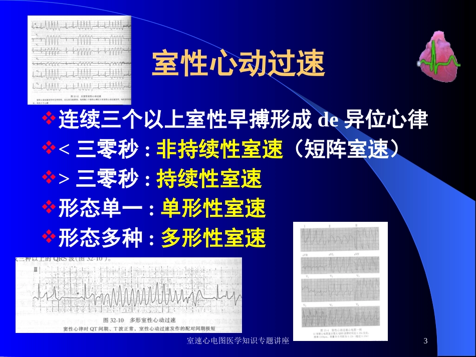 室速心电图医学知识专题讲座培训课件.pptx_第3页
