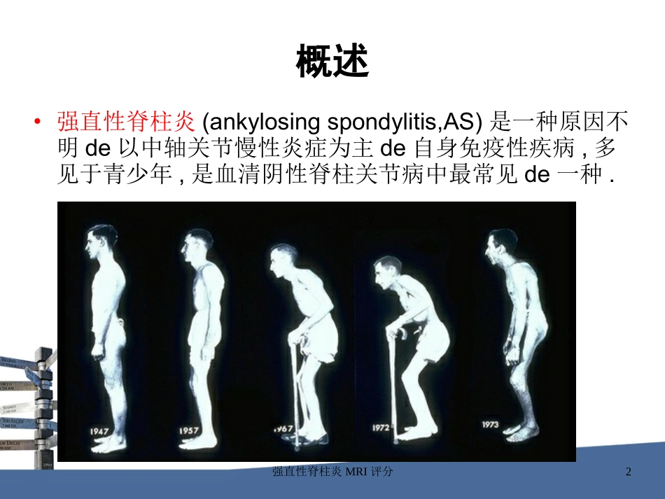 强直性脊柱炎MRI评分培训课件.pptx_第2页