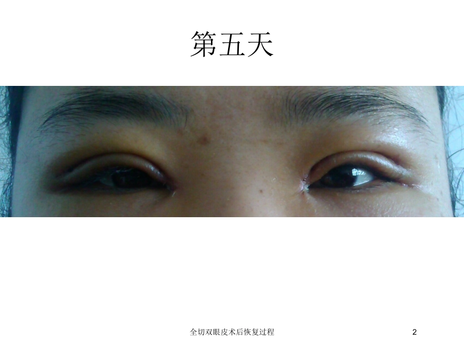 全切双眼皮术后恢复过程培训课件.pptx_第2页