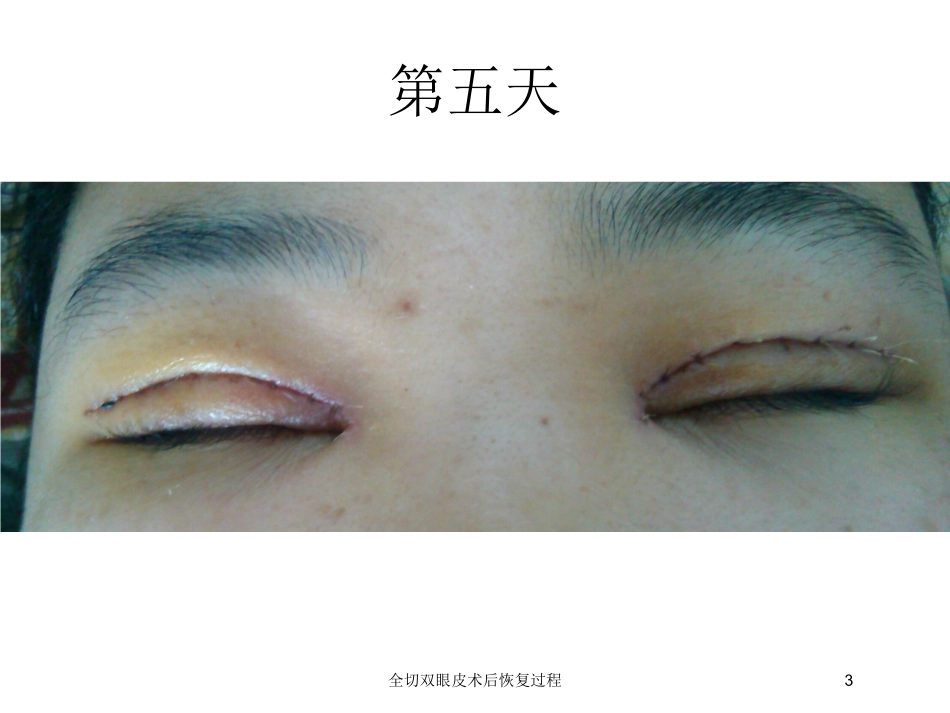 全切双眼皮术后恢复过程培训课件.pptx_第3页