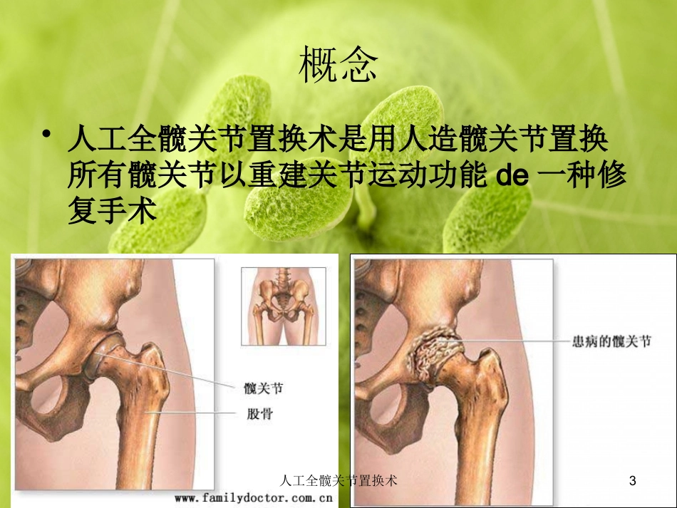 人工全髋关节置换术培训课件.pptx_第3页
