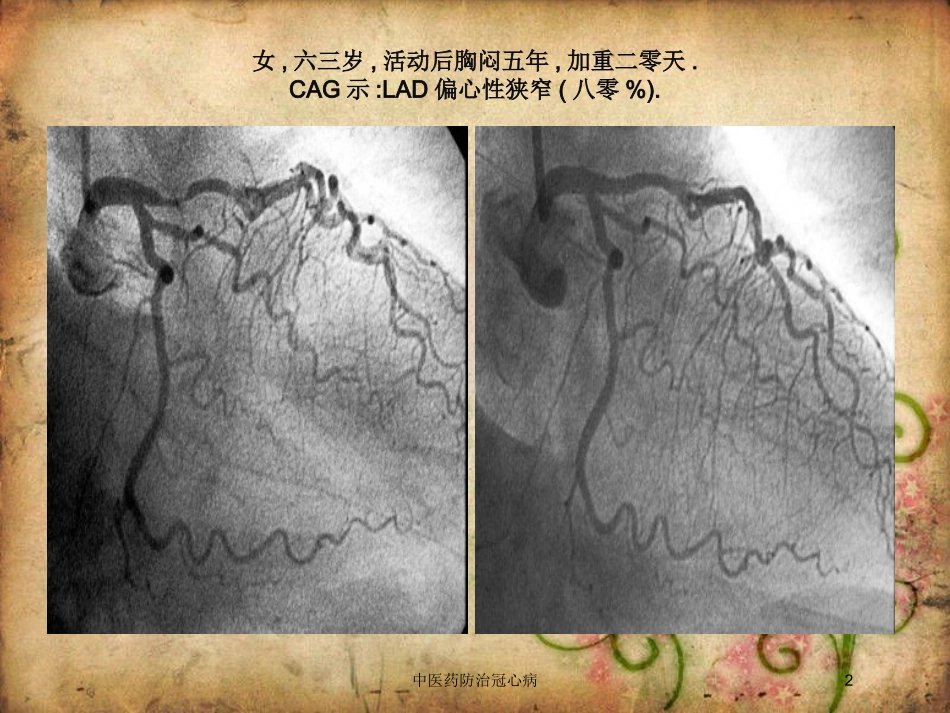 中医药防治冠心病培训课件.pptx_第2页