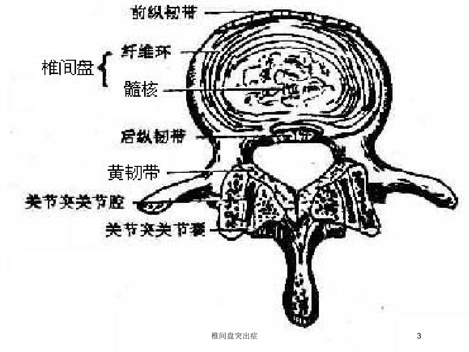 椎间盘突出症培训课件.pptx_第3页