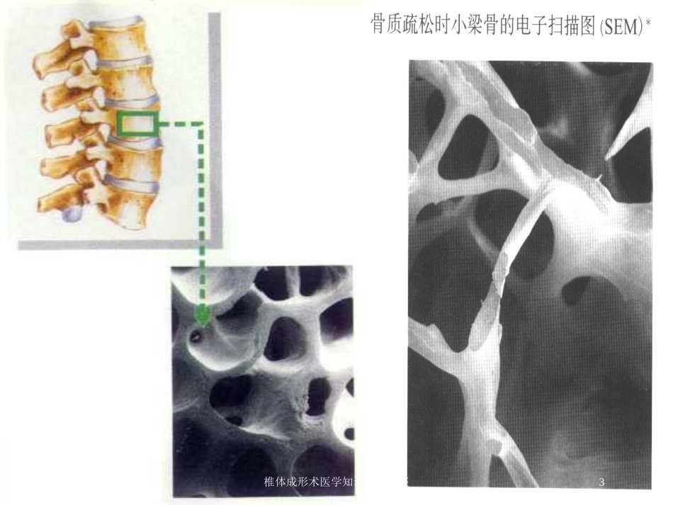 椎体成形术医学知识专题讲座培训课件.pptx_第3页