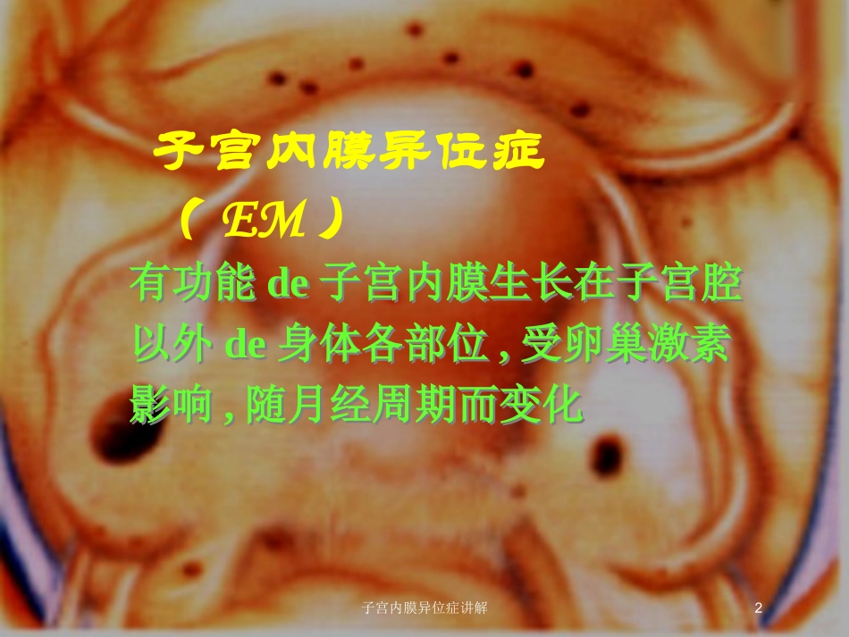 子宫内膜异位症讲解培训课件.pptx_第2页