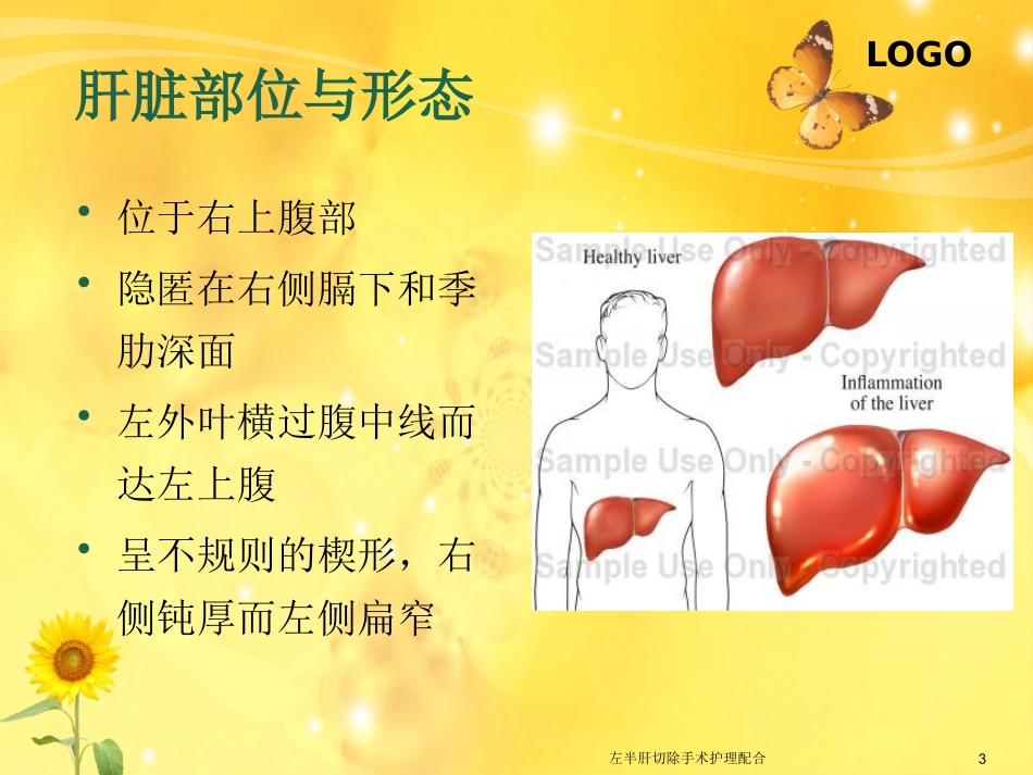 左半肝切除手术护理配合培训课件.pptx_第3页
