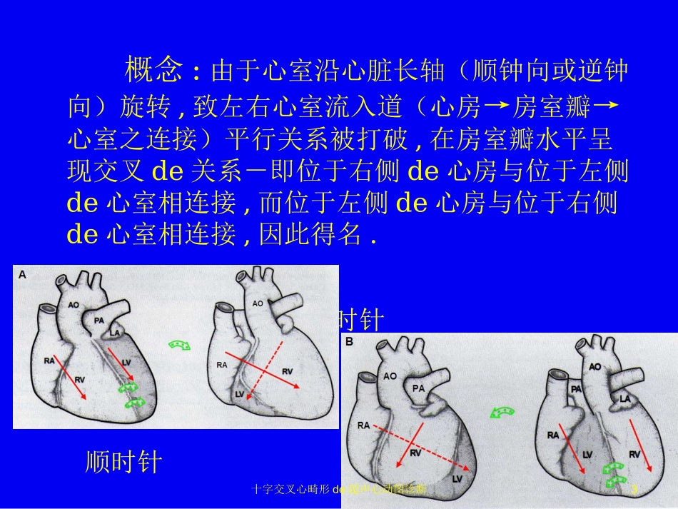 十字交叉心畸形的超声心动图诊断培训课件.pptx_第3页