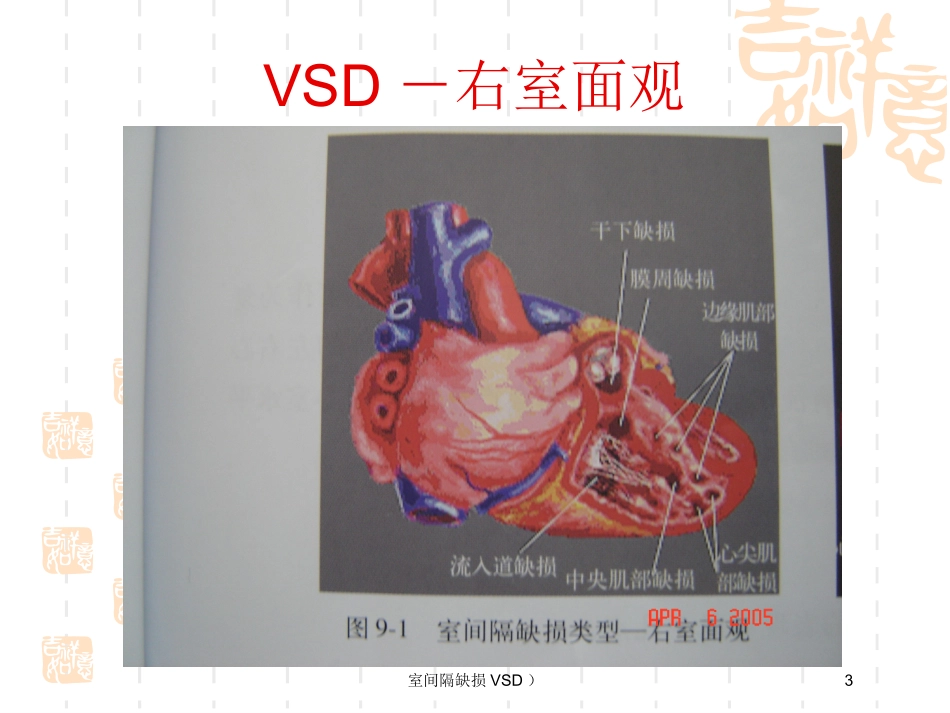 室间隔缺损VSD培训课件.pptx_第3页