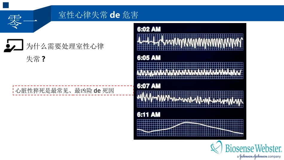室性心律失常的射频消融治疗培训课件.pptx_第2页