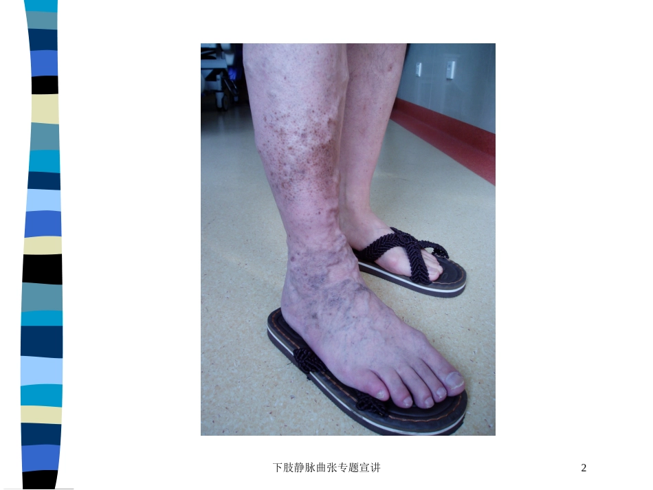 下肢静脉曲张专题宣讲培训课件.pptx_第2页