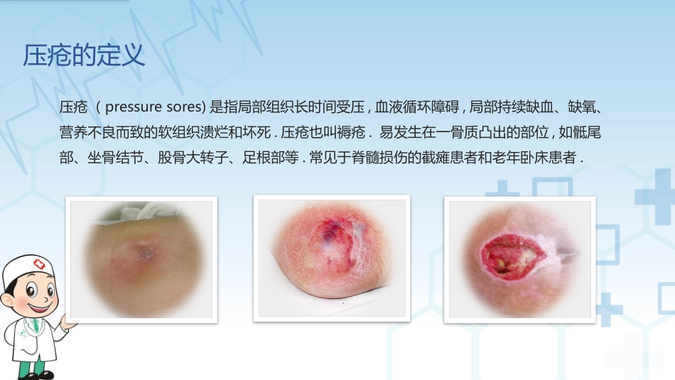 压疮的预防和护理健康宣传4.pptx_第3页
