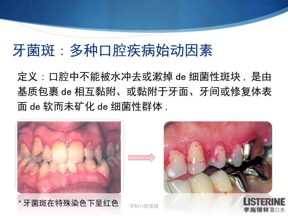 孕妇口腔保健培训课件.pptx_第3页