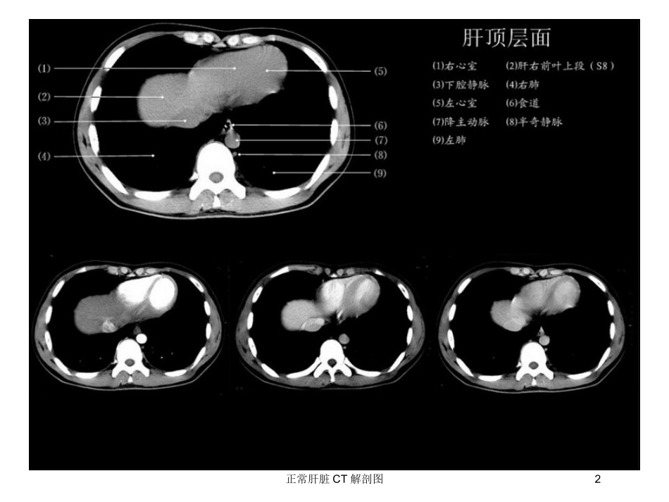 正常肝脏CT解剖图培训课件.pptx_第2页