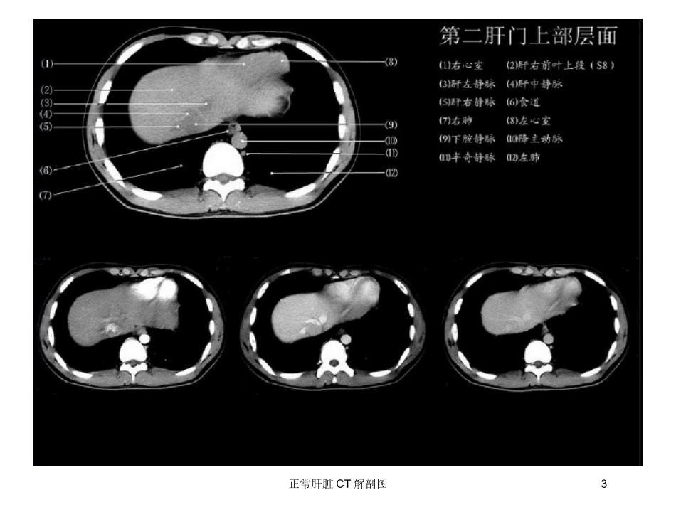 正常肝脏CT解剖图培训课件.pptx_第3页