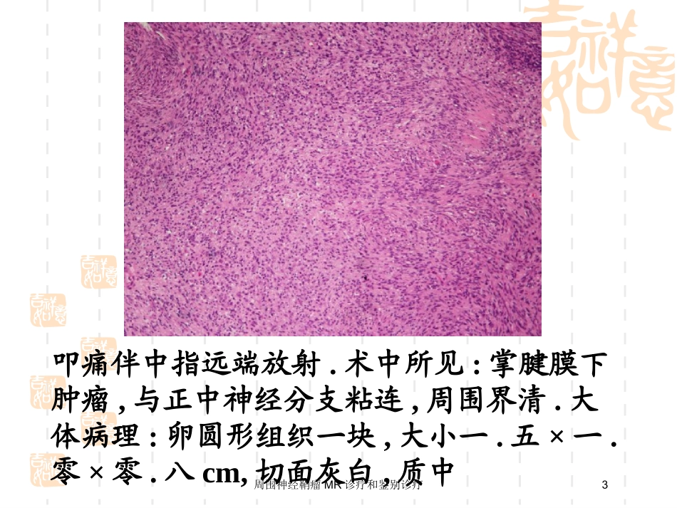 周围神经鞘瘤MR诊疗和鉴别诊疗培训课件.pptx_第3页