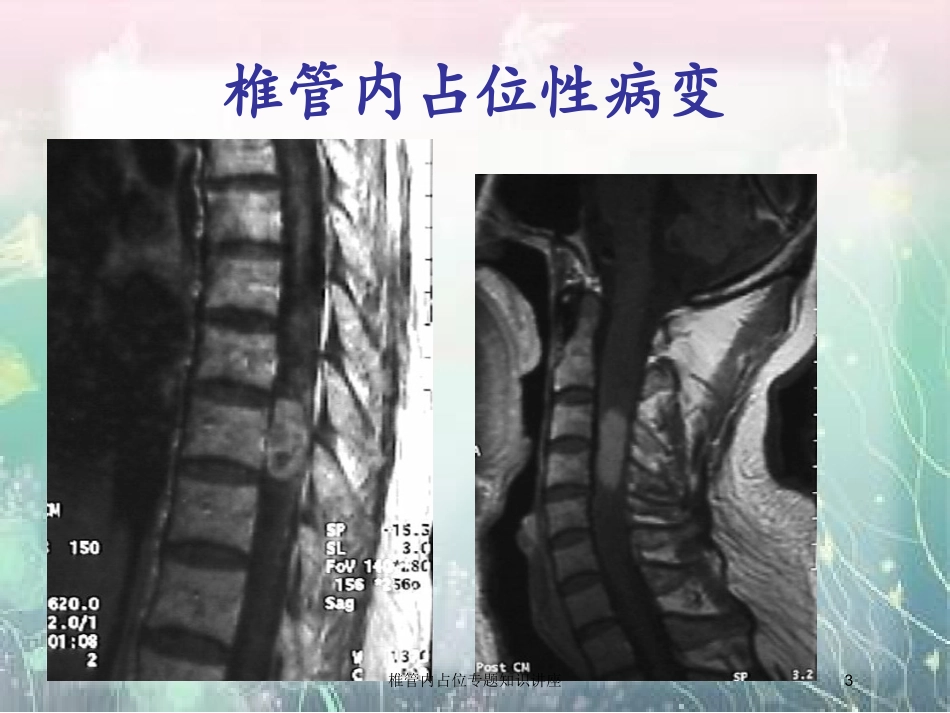 椎管内占位专题知识讲座培训课件.pptx_第3页