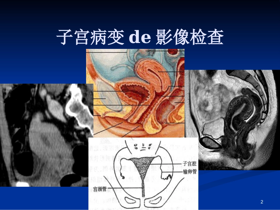 子宫恶性肿瘤的MR诊断培训课件.pptx_第2页