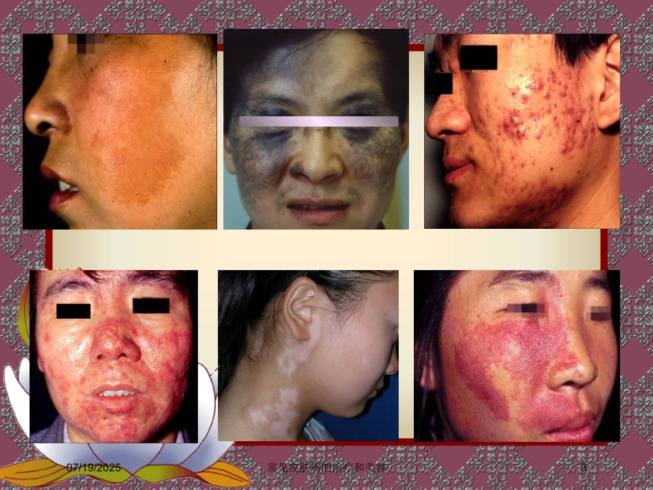 常见皮肤病的治疗和美容课件.pptx_第3页